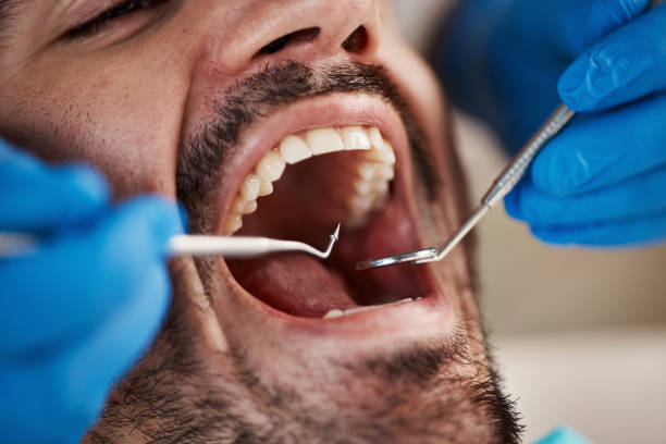 Best Emergency Treatment for Dental Infections or Abscesses in Kearns, UT