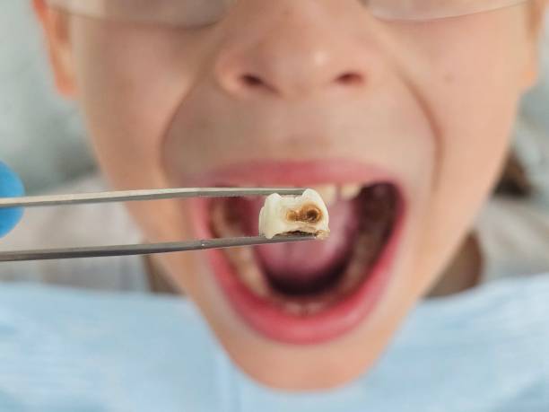 Best Emergency Tooth Extraction in Kearns, UT