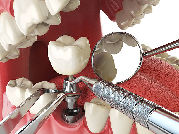 Best Emergency Wisdom Teeth Removal in Kearns, UT
